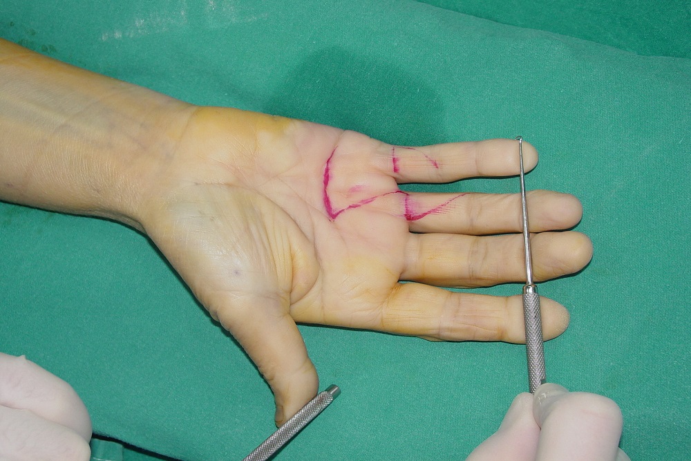 HAND SURGERY